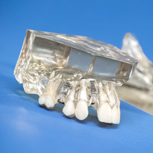 Zahnimplantate - Zahnersatz - Prothetik - Dr. med. dent. Gabriele Durst - Praxis für innovative und präventive Zahnmedizin
